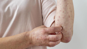 Brasil registra 55 casos de Mpox em 2026