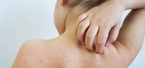 Sarampo cresce 32 vezes nas Américas em um ano; veja situação do Brasil